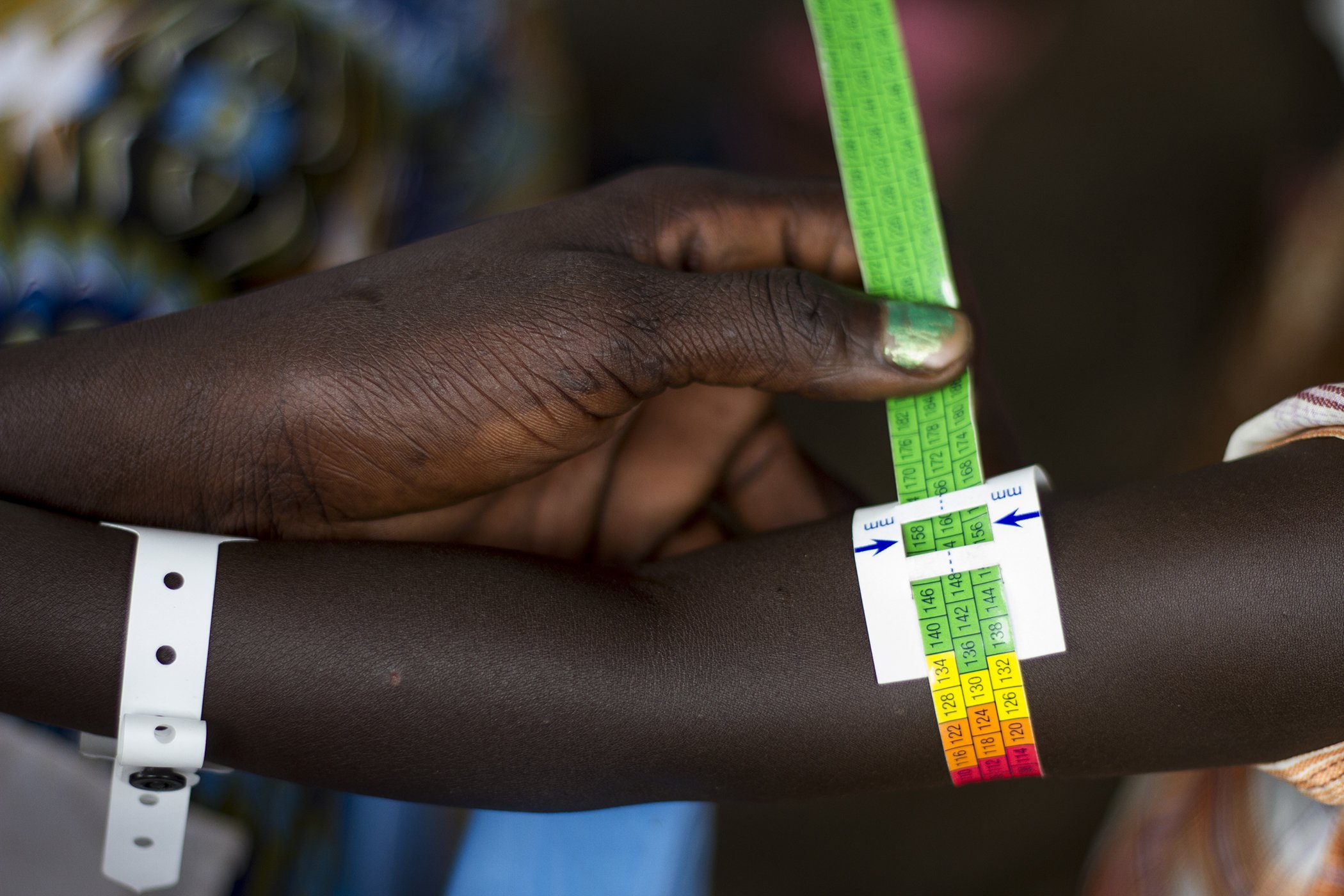 A Health professional attaches a malnutrition test kit on the forearm of a child refugee in South Sudan in June 2014.
