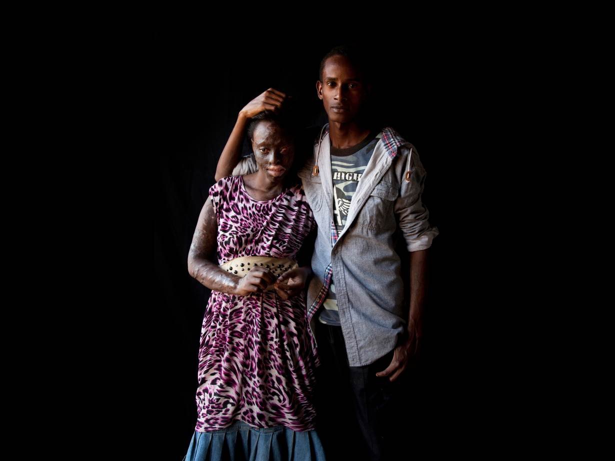 Portraits of Acid Attack Survivors Tell Stories of Courage